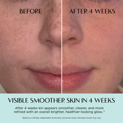Before and after comparison of skin smoother treatment showing visible improvement.